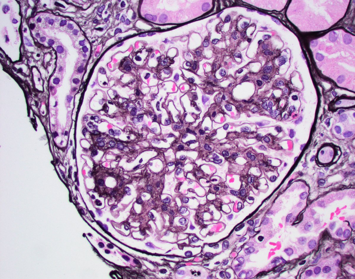 JZRenalPath's tweet photo. Fibrillary GN with linear staining potentially mimicking anti-GBM. Mesangial staining + mesangial expansion by silver weak material not typical for anti-GBM.  Also only focal crescents. fibrils infiltrating GBM on EM. #renalpath #pathtwitter #nephrology https://t.co/hIyynwjQXK