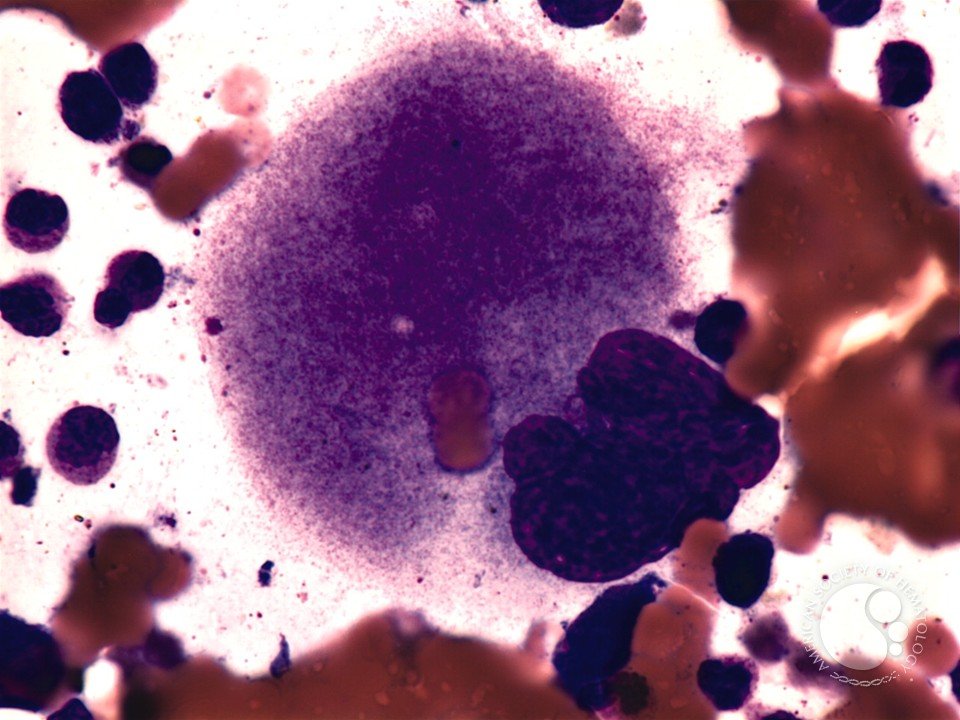 smbenlazar's tweet photo. Emperipolesis of red cells is seen in this megakaryocyte.| ASH Image Bank | American Society of Hematology https://t.co/gZ8pCTHmYo #ASHImageBank https://t.co/7OT2EOIzwp