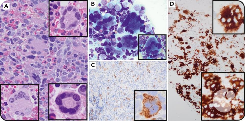 smbenlazar's tweet photo. “Ring-form” megakaryocytic dysplasia in STAG2-mutated myelodysplastic neoplasm | ASH Image Bank | American Society of Hematology https://t.co/pZSZLyFDOg #ASHImageBank https://t.co/DCgz7cSurK