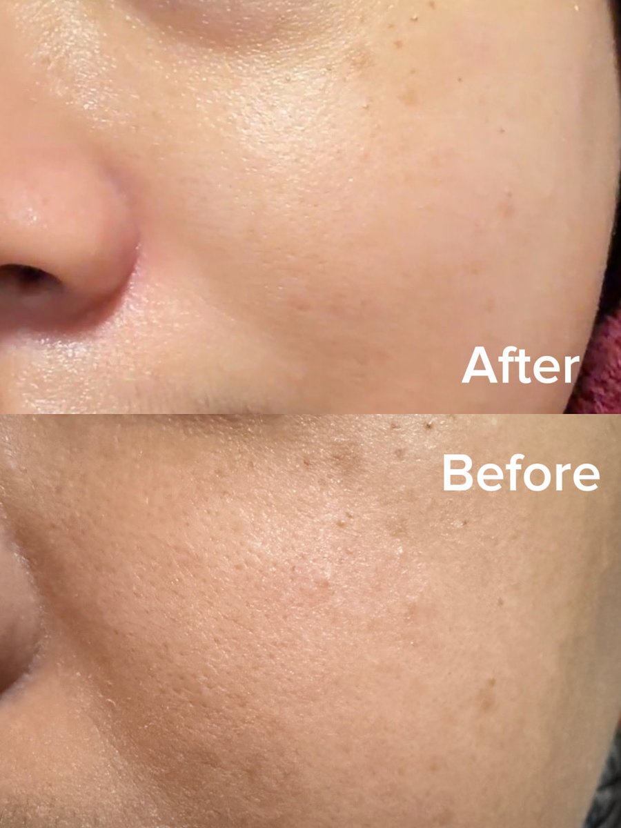 cikinsopee's tweet photo. If korang dah pernah introduce retinol &amp; bukan TTC, pregnant or breastfeeding, please add RETINAL in your skincare steps. KULIT MENOLAK TUA 🫣 https://t.co/XocofBoqYM