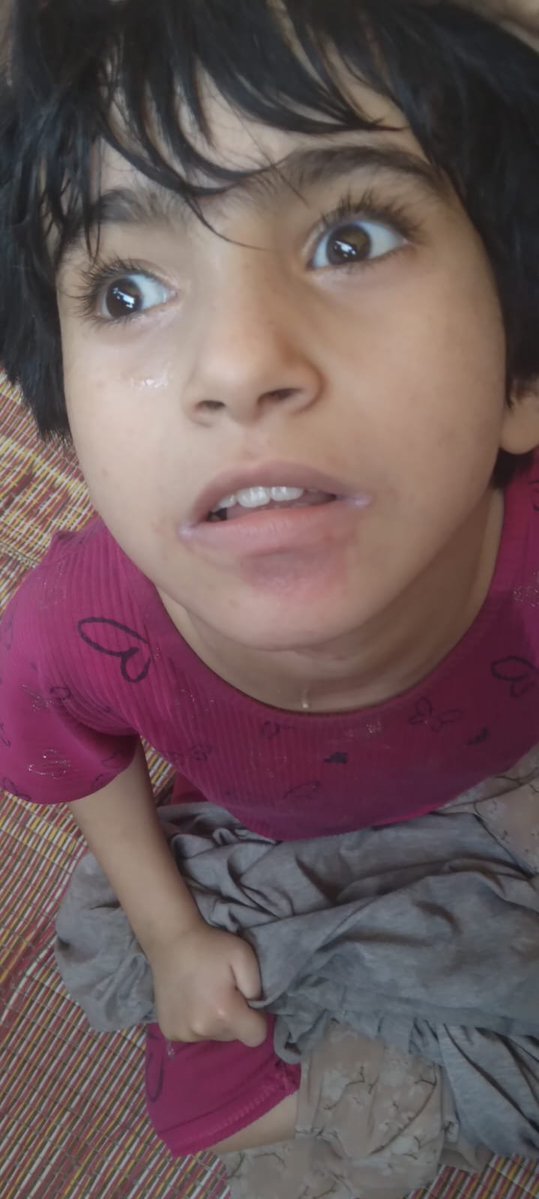 Zina16_5's tweet photo. Ma fille Zeina souffre d’une éruption cutanée étendue sur tout son corps. Elle est en situation de handicap et a besoin de soins et d’un traitement continus. 💔
S’il vous plaît, aidez-la, elle a désespérément besoin de votre soutien. 🙏🇵🇸
https://t.co/MkzfgYz5Qt https://t.co/TKX0CuJDZn