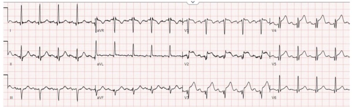 smithECGBlog's tweet photo. 4 patients with ST elevation, infection, and elevated troponin: which is Occlusion MI and which is myocarditis?

https://t.co/PFKQGgFNwB

@PMcardioApp @ECGcases https://t.co/OOTEHBZQZi