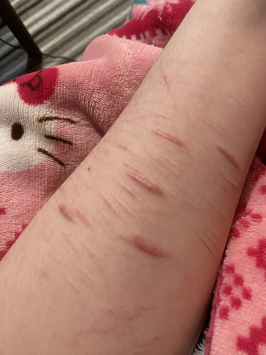 kiryumitlover's tweet photo. Scar tour idk???
Shrugs..
Peek the hello kitty blanket

Ive beeen clean for..fiveee weeks?
Five weeks too long..hmmm. But i have school so idk💔
AND ITS FUCKING HOT
(I scar easy. Some of these are lightly done. Obvi not the pink ones..)

#shtwt #shhtwt https://t.co/fN8hmxhBNe