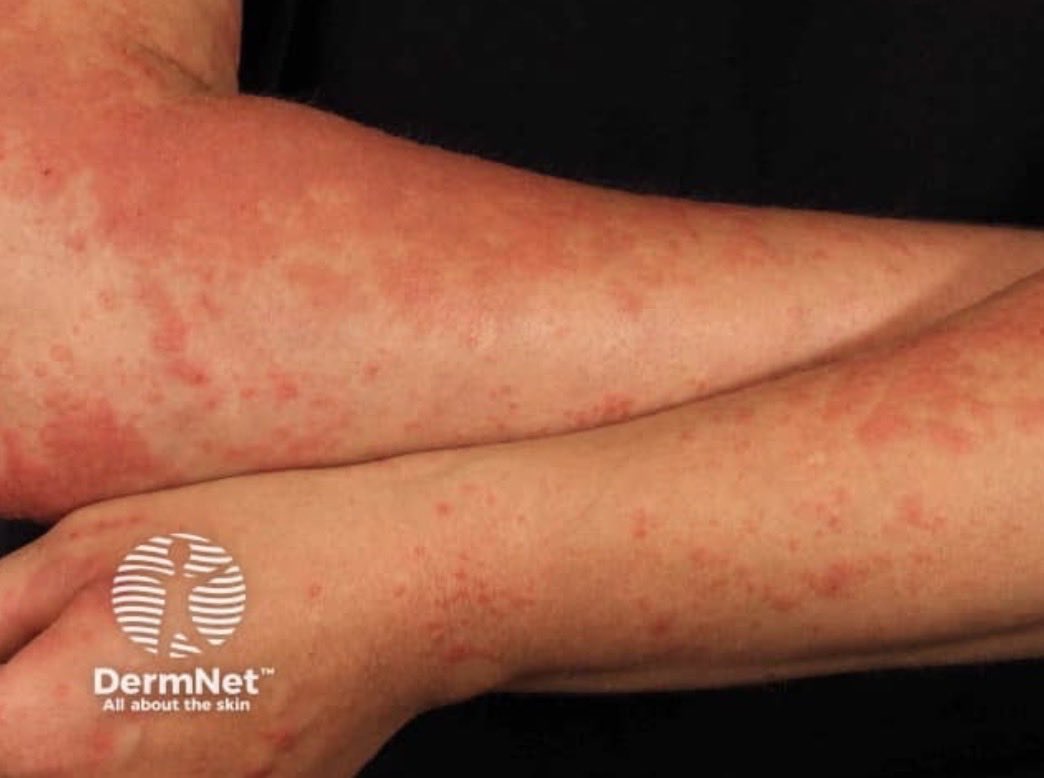 SkinofColorcomm's tweet photo. MONDAY MYSTERY!!

A patient develops an itchy, red rash on the arms after spending time outdoors in the sun. The rash appears several hours after sun exposure and tends to recur during the spring and summer. https://t.co/yLpiSJMiC6
