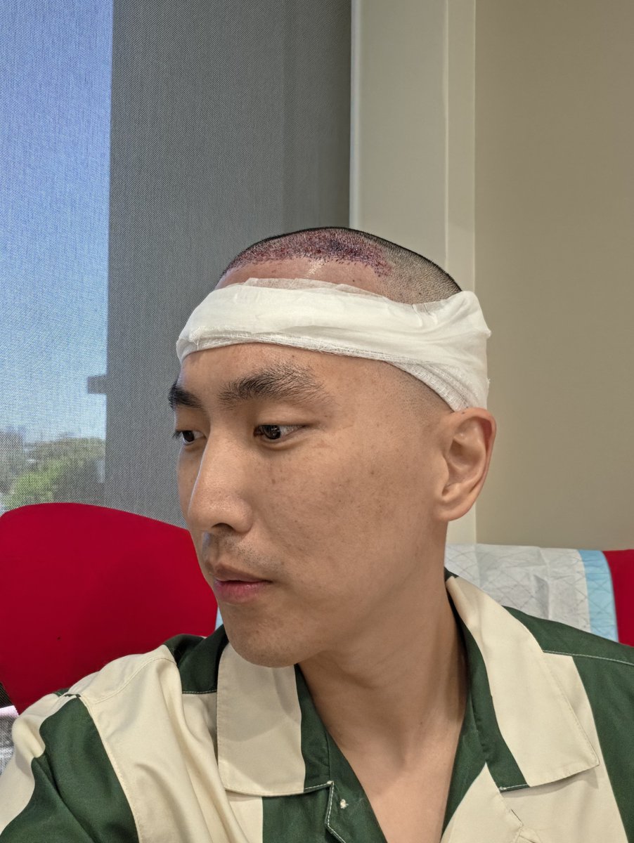 Doublelift1's tweet photo. hair transplant pre and post op 🤓 https://t.co/dHkfb4Rh1m