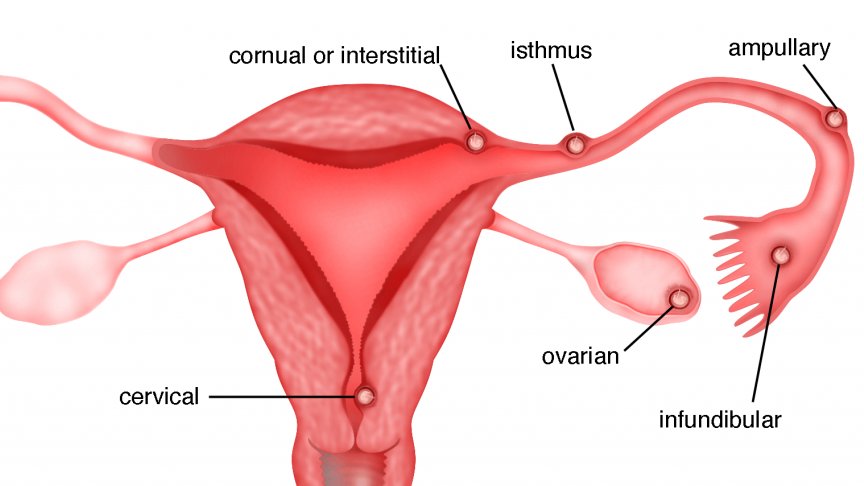 saikenMD's tweet photo. For those who don't know, a cornual pregnancy is an extremely rare type of ectopic pregnancy where the fertilized egg implants right at the segment where the fallopian tube crosses into the upper uterine horn (cornu). Because it implants in muscular tissue instead of the normal endometrium of the uterine cavity, this is ultimately incompatible with life. Unfortunately, due to the growth of the embryo itself, there is a high risk of uterine rupture and life-threatening hemorrhage, which is what ultimately happened in Lala's case. 3L of blood is more than half of the body's total blood volume, and it is a miracle that Lala survived this ordeal and could even share this story with us. Please send all of your love and support to her and Dondon.