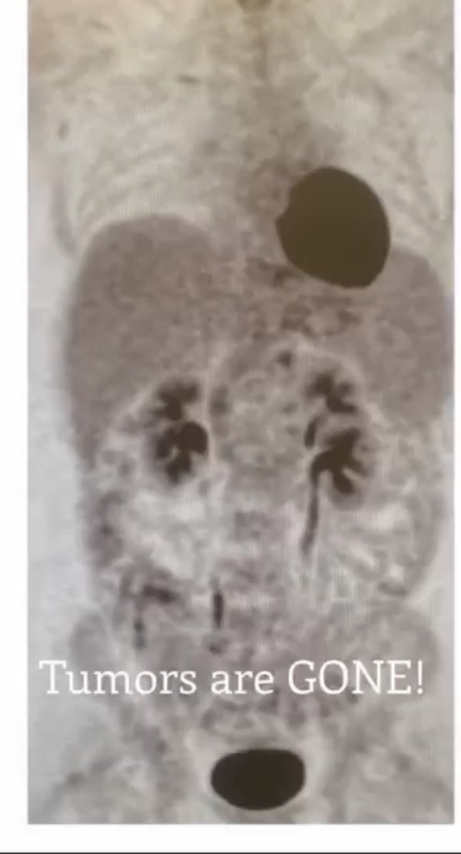 DrDavidivw's tweet photo. PROTOCOL I USED IN THE MANAGEMENT OF A STAGE IV ESOPHAGEAL CANCER CASE

FENBENDAZOLE: 222mg x2 daily 

IVERMECTIN: 100mg x1 daily 

MENBENDAZOLE: 100mg x1 daily 

DMSO:
BLACK SEED OIL:
VITAMIN D3:
TURMERIC CURCUMIN:

And other supplements included in the kits https://t.co/3brnTLkZIn