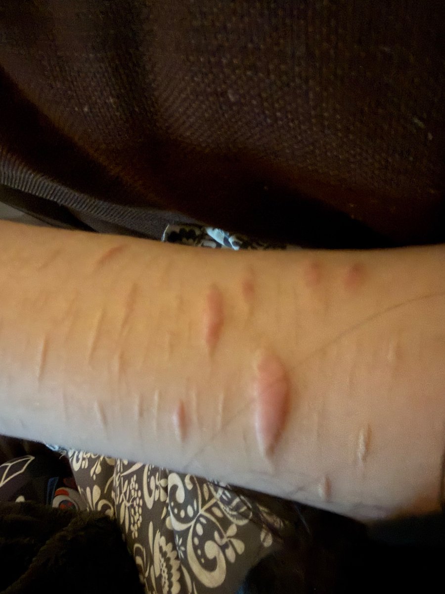 icingfilled's tweet photo. How to make my scars get big like this again . They only styro https://t.co/Ros6QPP6WC