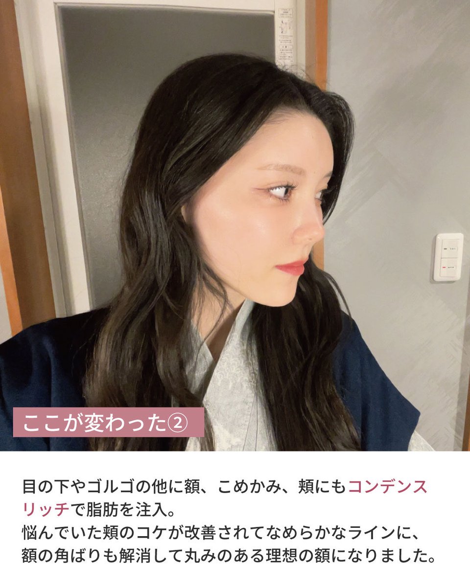sbc_takesako's tweet photo. クマ取りで目の下のふくらみ・影をなくし���、明るいお目元に✨
脂肪注入で額こめかみ・ゴルゴライン・頬のコケを埋めて、綺麗な卵形の輪郭に☺️
かなり痩せ型のお客様でしたが、リジェネラを併用することで脂肪の定着率がグッと上がり、半年経ってもまんまるおでこをキープできました🤭
#クマ取り https://t.co/if7y8qWCGd