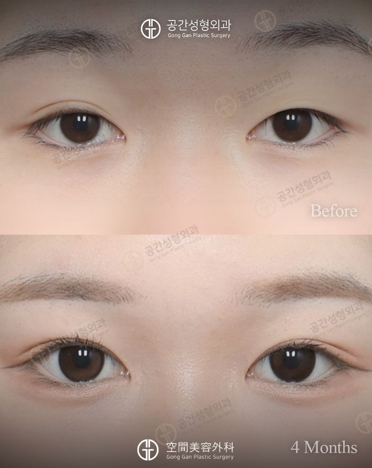 gongganclinic's tweet photo. 【目整形症例】

手術内容
✓二重切開
✓目つき矯正

目頭から目尻にかけて
二重幅が広がるインアウトラインにデザイン✨

眼瞼下垂がある方は、目つき矯正も一緒に行うことで
黒目の露出が増え、よりはっきりとした華やかな目元になります◎

••••••••••••••••••••••••••••••••••••••  

初手術・再手術どちらも “どこで・誰に受けるか” が重要です👍🏻 

ハム院長は 初手術はもちろん、再手術の症例経験も豊富で 多くの患者様からご相談をいただいております👨🏻‍⚕️

お一人おひとりのバランスに合わせて 自然で美しい目元・お鼻をデザインいたします😌

「初めてで不安な方」 「他院修正でお悩みの方」 どちらもお気軽にご相談ください🤍

* ┈ ┈ ┈ ┈ ┈ ┈ * ┈ ┈ ┈ ┈ ┈ ┈ *

👨🏻‍⚕️17年以上の実績をもつハム・ギウォン院長
🪡目・鼻 / 再建・修正 など 
🩻CT検査・アフターケア���備 
🙆🏻‍♀️日本語対応
📍新沙駅6番出口 徒歩1分 
💌ご予約・お問い合わせはLINEまで： https://t.co/E2uVxJctr0

#二重整形 #韓国整形 #空間美容外科