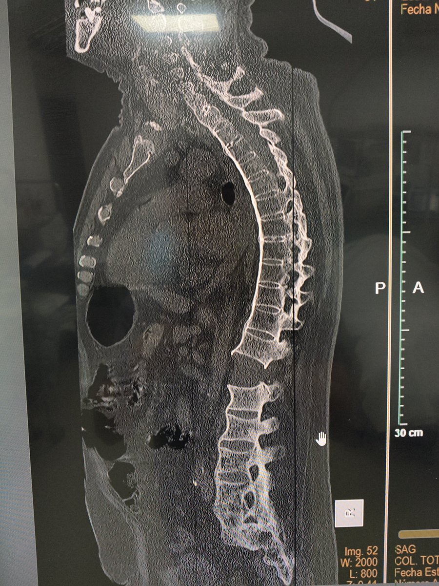 Torlsteinacst's tweet photo. Tremendo el espinazo
#spinesurgery #aospine #radiology #orthopedicsurgery #medicine #traumatology https://t.co/kAZyxZroKL