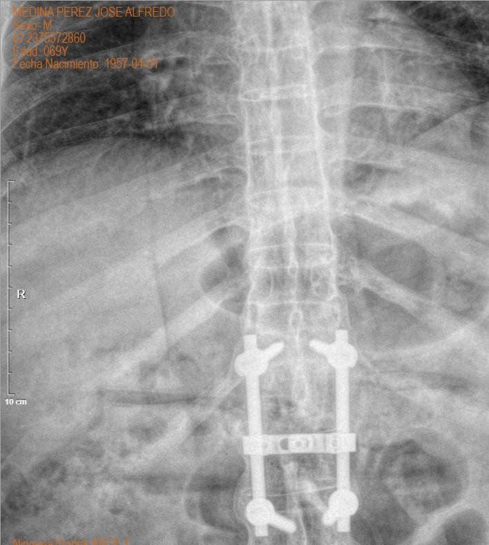 Torlsteinacst's tweet photo. Tremendo el espinazo
#spinesurgery #aospine #radiology #orthopedicsurgery #medicine #traumatology https://t.co/kAZyxZroKL