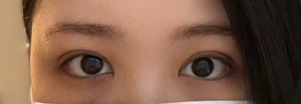 prettypricky's tweet photo. ←before
→after

イエロー美容整形外科@yellowps_jp で自然癒着と目上切開の施術を受けました。

元々左右左のある目で日本で1度施術済み、今回は修正です。
埋没の糸が緩んでいて目頭の形も左右左がありましたが、それも緩和されて二重幅も綺麗に均一になったのでとても満足してます。

※術後1週間 https://t.co/whwbTzO9ee