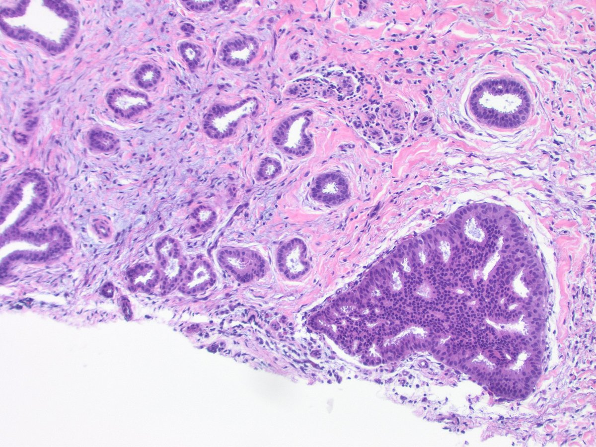 SandraIxchelS's tweet photo. A busy busy breast biopsy!  Throwing out all the breast diagnoses on this one 

#breastpathology 
#pathology https://t.co/WJkyAj2W9q