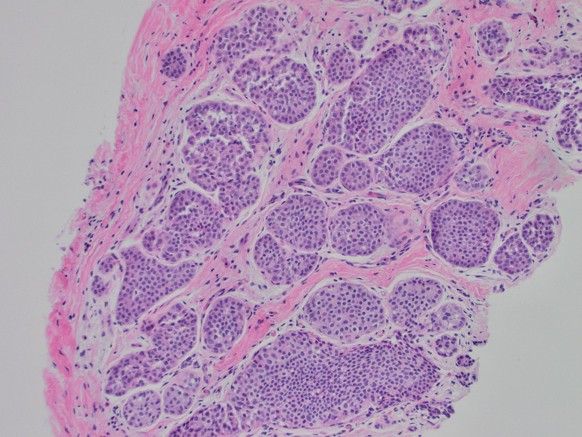 SandraIxchelS's tweet photo. A busy busy breast biopsy!  Throwing out all the breast diagnoses on this one 

#breastpathology 
#pathology https://t.co/WJkyAj2W9q