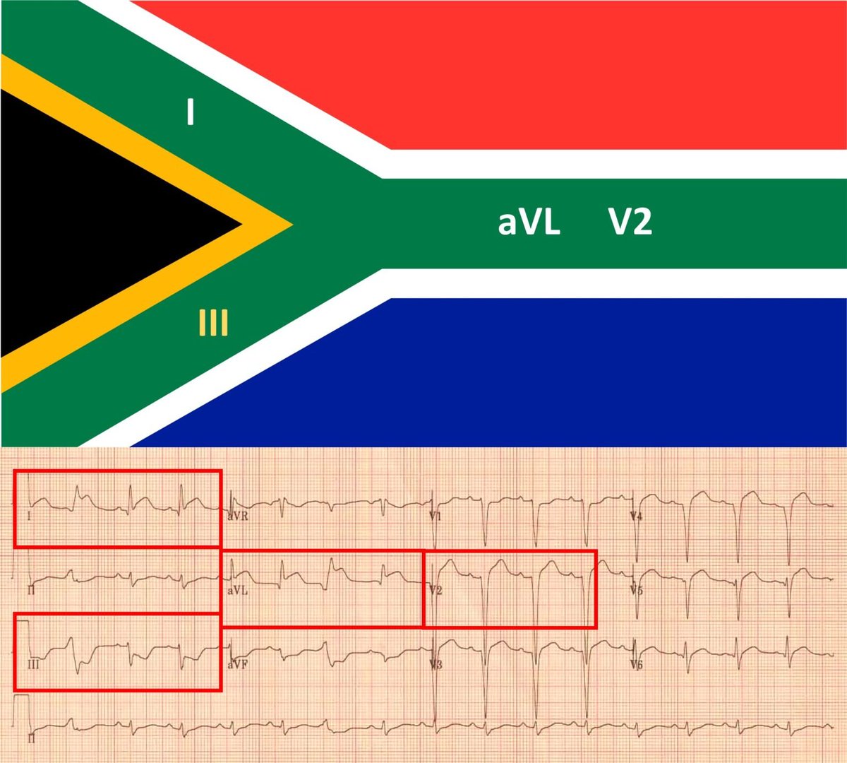 TrackYourHeart's tweet photo. 🇿🇦 😍
A patient presents with acute chest pain.
1. Name this clinical sign 
2. What is the most likely culprit lesion? https://t.co/fMWyZKHx3c