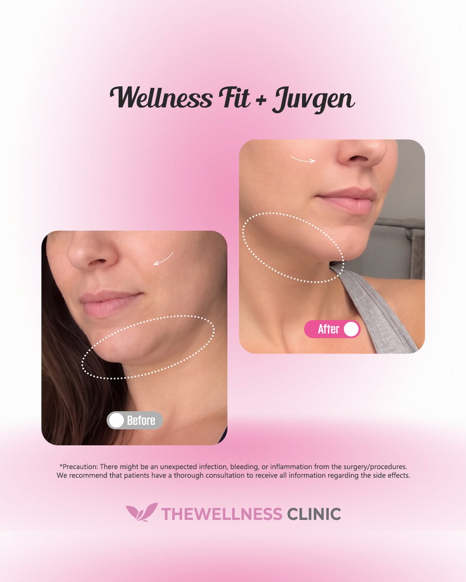 thewellnessen's tweet photo. 📢 Ready to slim lower-face bulk and restore natural volume? 📩 DM for reservations &amp; consultations
🕒 M–F 09:00–20:00 | Sat 09:00–16:00 | Sun 10:00–17:00 🏥 The Wellness Clinic 2F, Banpo Shopping Town Bldg. 8, 219 Sinbanpo-ro, Seocho-gu

#TheWellnessClinic #WellnessFit #Juvgen https://t.co/57h7jU6JIv