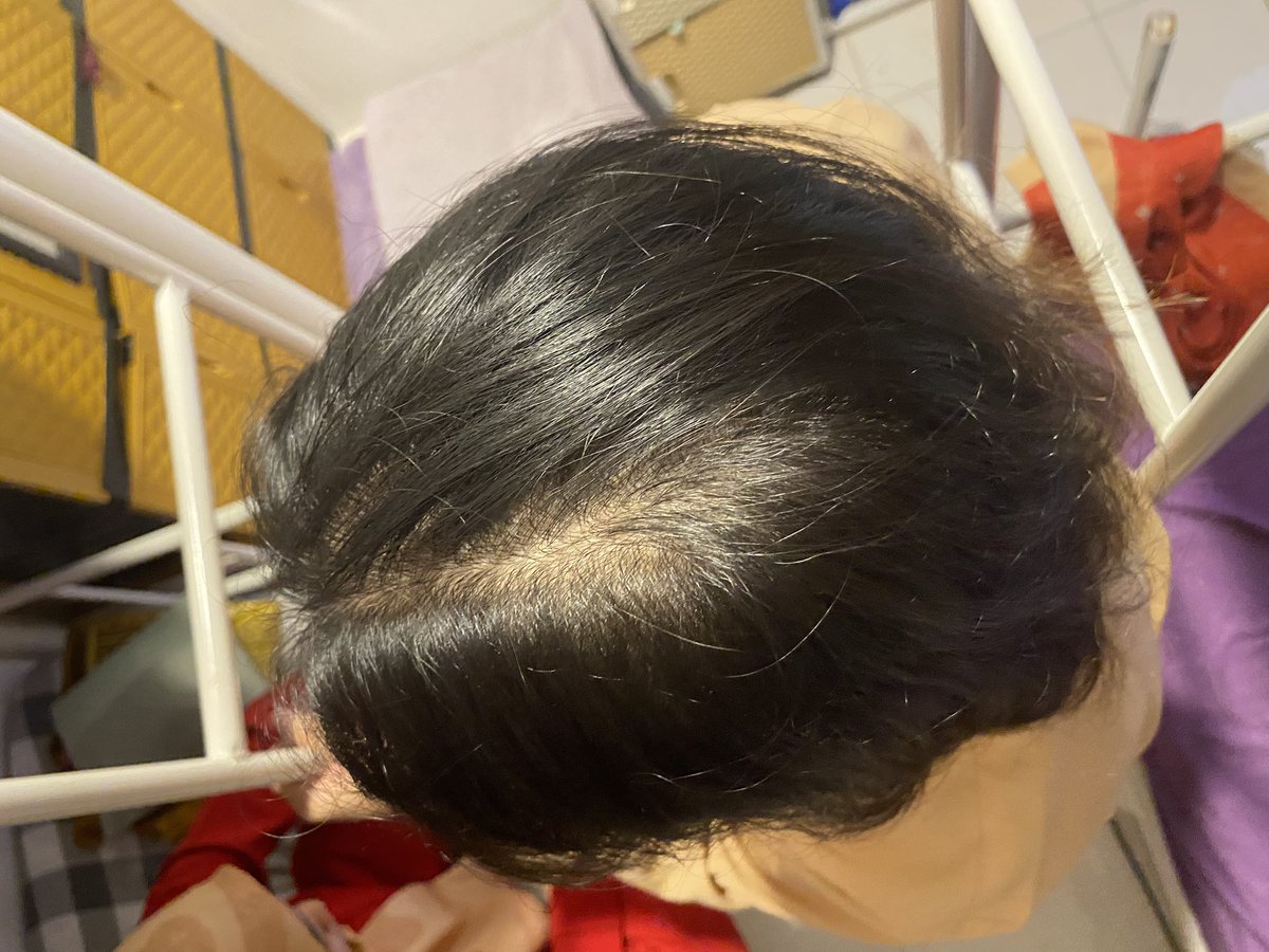 artemiies's tweet photo. Beneran deh, as people yang struggle numbuhin rambut itu beneran sih nyari product yang bikin rambutnya cepet growth tuh cocok cocokan ya kan? 

Before                                             After https://t.co/EekEKECVZn