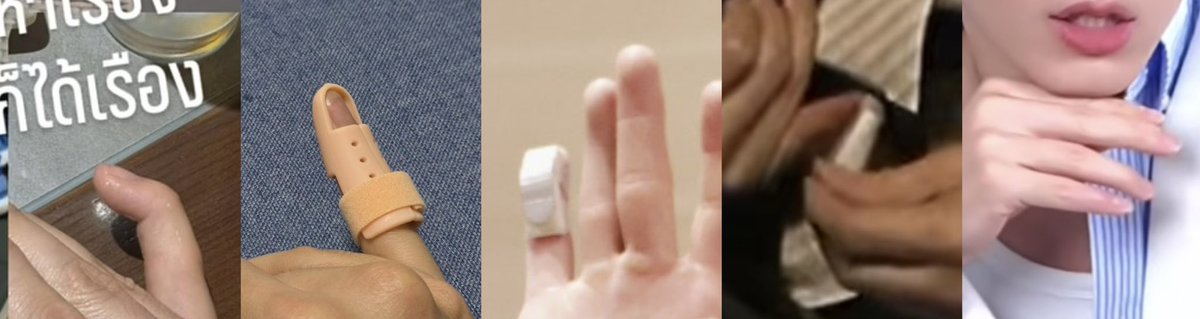 peachysnow22's tweet photo. 05/26 post-injury:
tendon rupture
pinky fingertip dropped

06/01 first treatment:
8 weeks full-time splint

07/29 stax off:
still wearing aluminum splint 

07/31 aluminum splint off:
still taped

08/06 splint fully off:
all pretty ✨ 
all straight (finger)
a bit swollen

#Newwiee https://t.co/TvoMJlOnbu