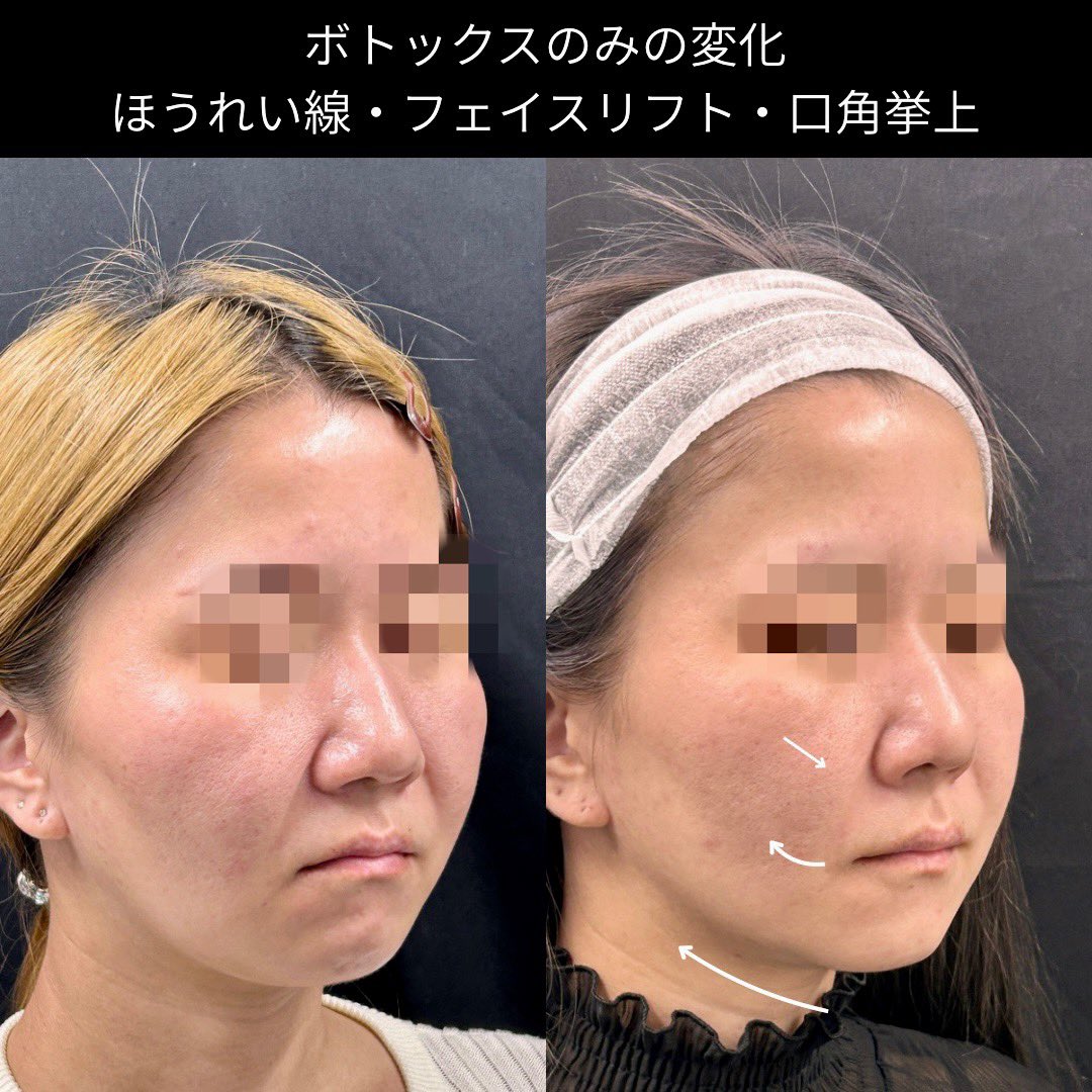 Biyou_no_DR's tweet photo. ボトックスのみでリフトアップ•口角挙上•ほうれい線&マリオネットライン改善

重力だけでなく持続的な筋肉の緊張はタルミやシワを創ります。
特に下顔面は若年者でも無意識に力が入っている方も多いのでボトックスだけでも改善させる事は可能です（派手な変化ではありませんが）。

この症例の注入箇所としては、上唇鼻翼挙筋・上唇挙筋・口角下制筋・頤筋・広頸筋に対するボトックス治療です
単体では、ガミースマイル、口角挙上、梅干しジワ、ボトックスリフト
と呼ばれる治療ですが、適応が良い状態だとオペは勿論、ヒアルや糸リフト中HIFUなしでもアンチエイジング治療としてナチュラルに若返りが可能です。

動かすときに口元に多少の違和感を感じる可能はありますが表情の不自然さはありません。

#ボトックスリフト　#フェイスリフト
#貴族フィラー　#口角挙上