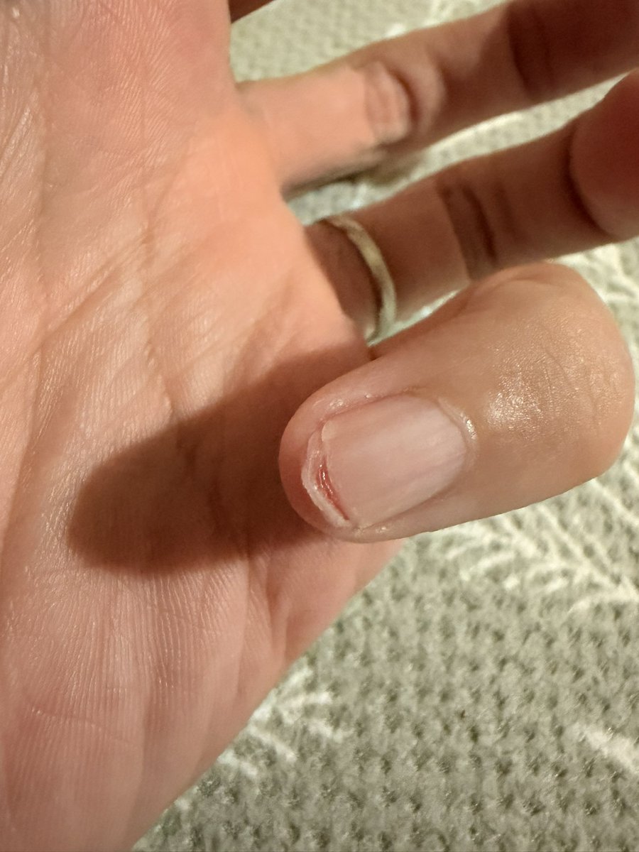 naopon_10_'s tweet photo. 爪剥がれて風にあたるだけで痛いよ🤕 https://t.co/ZO2SLOIcmU