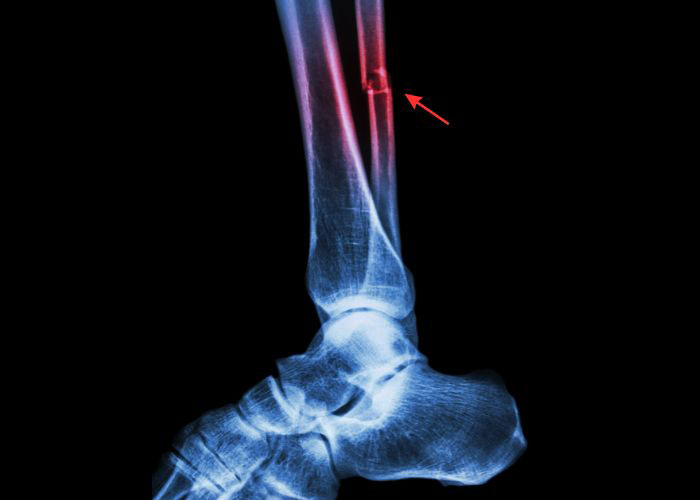 sportsfootankle's tweet photo. Athletes don’t return to sport because a fracture disappears on an X-ray. They return when the #ankle has regained stability, strength, and trust. Treating #fibula fractures requires a plan focused on both healing and performance. https://t.co/13ILmtmWEk #fibulafracture https://t.co/LyeM4okZJ1