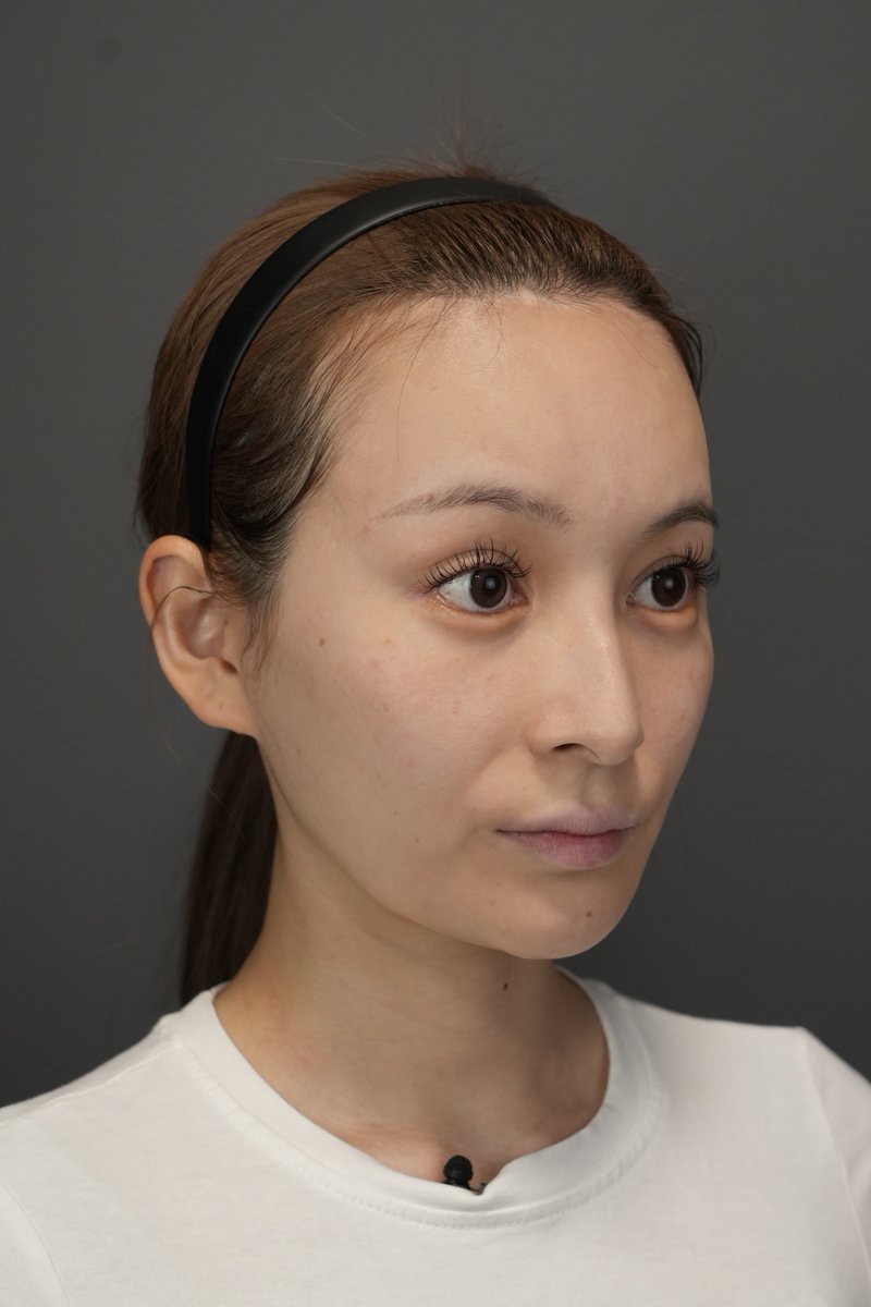 dr_omiomi's tweet photo. 顔の脂肪は「減らす治療」ではなく、「重心を変える治療」です。

「たくさん取れば小顔になる」と思って脂肪吸引をすると、頬こけや老けた印象になってしまうことがあります。

大切なのは、顔の重心を高くしてメリハリを作ること。

顎下はしっかり脂肪を取り、フェイスラインをシャープにします。
ただし、そのままだと皮膚のたるみが出ることがあるため、クォンタムRFやネックリフトを併用して皮膚をピタッと引き締めることが重要です。

また、口横のUPPERジョールからメーラー下部のナゾラビアルファットをピンポイントで整えることで、鼻や口の埋もれ感が改善し、顔全体の重心が上がります。

その結果、目・鼻・口のパーツがより際立ち、自然に垢抜けた印象になります✨

症例は脂肪吸引＋糸リフトのビフォアフ。