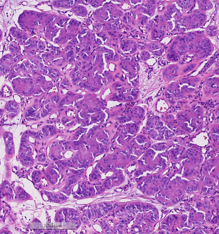 Janiranavarro's tweet photo. HTT (hyalinizing trabecular tumor)

Rare follicular-derived thyroid tumor with trabecular growth, hyalinized stroma, and PTC-like nuclei

Once considered a PTC variant; now regarded as benign or of low malignant potential.

Shows unusual membranous/cytoplasmic MIB-1 (Ki-67) staining, but only when the stain is done at room temperature (rarely seen in routine practice)

Dr. Scognamiglio #USCAP #pathology #PathX #PathTwitter