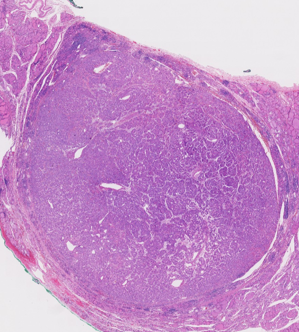 Janiranavarro's tweet photo. HTT (hyalinizing trabecular tumor)

Rare follicular-derived thyroid tumor with trabecular growth, hyalinized stroma, and PTC-like nuclei

Once considered a PTC variant; now regarded as benign or of low malignant potential.

Shows unusual membranous/cytoplasmic MIB-1 (Ki-67) staining, but only when the stain is done at room temperature (rarely seen in routine practice)

Dr. Scognamiglio #USCAP #pathology #PathX #PathTwitter