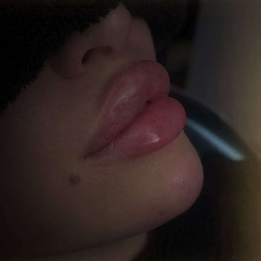 dr_laracheajfuc's tweet photo. Lips &amp; Chin
Lips volume will decrease ~ 40 % https://t.co/a57vIuWHru