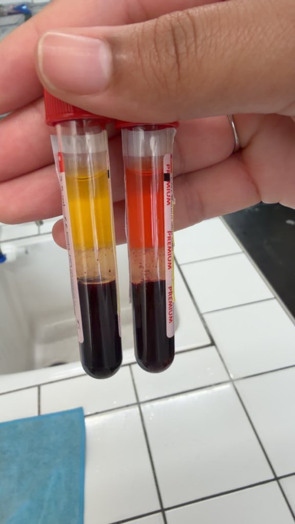 EphemereLife9's tweet photo. @Dilaraabmw Pendant que moi j’ai un tube qui présente une hémolyse. En + pour une analyse de potassium et de LDH🥲 https://t.co/w2VrRma7kA