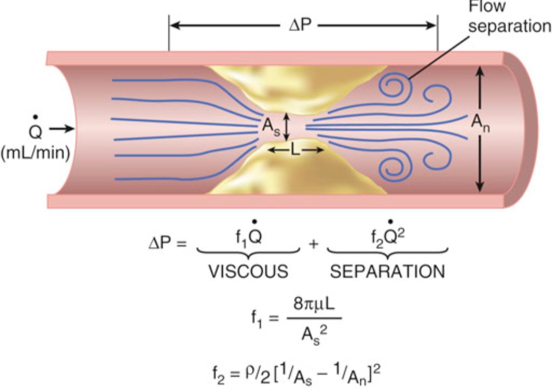 TrackYourHeart's tweet photo. Why does a coronary stenosis reduce blood flow?

The pressure drop across a coronary stenosis is governed by basic fluid mechanics. As the arterial lumen narrows, blood must accelerate through the tightest segment, increasing energy loss and reducing pressure distal to the lesion.

Two mechanisms contribute to the pressure gradient across a stenosis:

◼️ Viscous friction: Blood rubbing against the narrowed vessel wall causes gradual energy loss. This component increases in proportion to blood flow and is influenced by blood viscosity, stenosis length, and the minimum lumen area.

◼️Flow separation (turbulence): After blood exits the narrowed segment, it decelerates abruptly, creating vortices and turbulence. This results in additional energy loss that rises with the square of blood flow, making it the dominant mechanism during hyperemia or exercise.

The Bernoulli principle explains this relationship:

ΔP = Viscous losses + Separation losses

As stenosis severity increases: 
🔻The minimum cross-sectional area becomes smaller. 
🔻 Blood velocity through the stenosis increases. 
🔻 The pressure drop rises disproportionately, especially at higher flow rates.

This explains why many patients with moderate coronary stenoses have little or no ischemia at rest but develop angina during exercise. At rest, coronary flow is relatively low and the pressure gradient is modest. During stress, the required increase in coronary flow causes a much larger pressure drop, reducing distal coronary perfusion.

These hemodynamic principles form the physiological basis of fractional flow reserve (FFR) and other invasive coronary physiology measurements, which determine whether a stenosis significantly limits myocardial blood flow.

Reference: Braunwald's Heart Disease: A Textbook of Cardiovascular Medicine