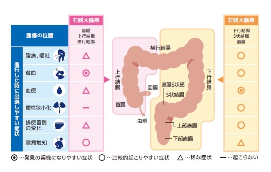 trombe___'s tweet photo. あ、今回手術したの、左の横行結腸の角あたりに腫瘍があったので、そこの手前から後ろの腸を切る手術となりました。
こうやって兆候見たら、便通悪くなったり血便してたりあったからもっと早めにカメラやったほうが良かったのかなぁって後の祭り。 https://t.co/3mKY0LpSX1