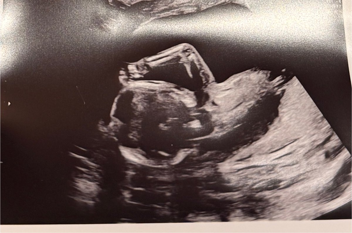 piaolink's tweet photo. 【ご報告】新しい命を授かりました🍀👶

16週に入りつわりも落ち着いたところです。

ガッツポーズをキメてるちょ子（ちょの子どもでちょ子）さんです。

出産は1月予定！赤ちゃんに会える日を楽しみながら、今だけの夫婦の時間、そして自分の時間も大切に過ごしていこうと思います✨ https://t.co/bgTPEGHKlM