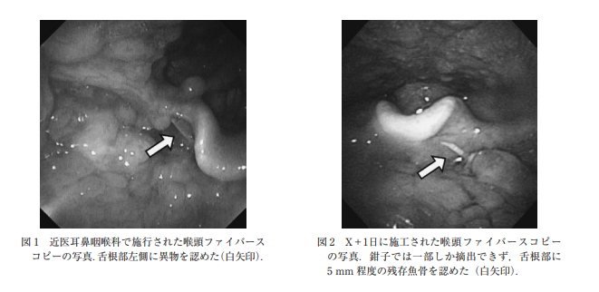 AoringoDr's tweet photo. 🐟️「たかが魚の骨でしょ」と侮らないでください。
最悪の場合、子どもが全身麻酔で摘出手術をすることになります。 

実際に給食のお魚を食べて骨がのどに刺さり、救急受診から入院に至った事例（【Injury Alert No. 87】）が報告されています。お子さんを守るための大切な対策をまとめました👇

🐟 実際の事例（9歳女の子） 
・タラの切り身を食べていたところ、のどに違和感が。うがいをしても取れず耳鼻咽喉科を受診しました。 
・しかし、奥深くに刺さっており外来では摘出できず…。翌日、救急室にて全身麻酔（静脈鎮静・気管挿管）を行い、ようやく摘出されました。

⚠️ 放置するとどうなる？
・ 刺さった魚の骨は自然に取れることもありますが、埋もれて化膿したり（咽後膿瘍）、気道に入り込んだり、まれに腸に穴が開いてしまう（消化管穿孔）など、深刻な事態になるリスクがあります。 
・特に「アジ、ウナギ、サケ、サンマ、サバ、カレイ」など、食卓によく出るお魚は要注意です。

💡 事故を防ぐための対策 
① 「骨なし魚」を活用する
② 食べる前に細かくほぐし、小骨を取り除く 
③ 「よく噛む」ことを教える （50回以上噛むと、小骨は魚肉と区別がつかない程度まで細かく砕かれるという報告もあります）
 少しの工夫でリスクを大きく減らせます。

もし刺さってしまったら、無理に取ろうとせず、すぐに耳鼻咽喉科を受診してください。
（※昔ながらの「ご飯を丸飲みさせる」は、さらに奥深く刺さる危険があるので絶対にNGです！）

子どもたちが安全に美味しくお魚を食べられるよう、この投稿をリポストで広めてもらえると嬉しいです🍎