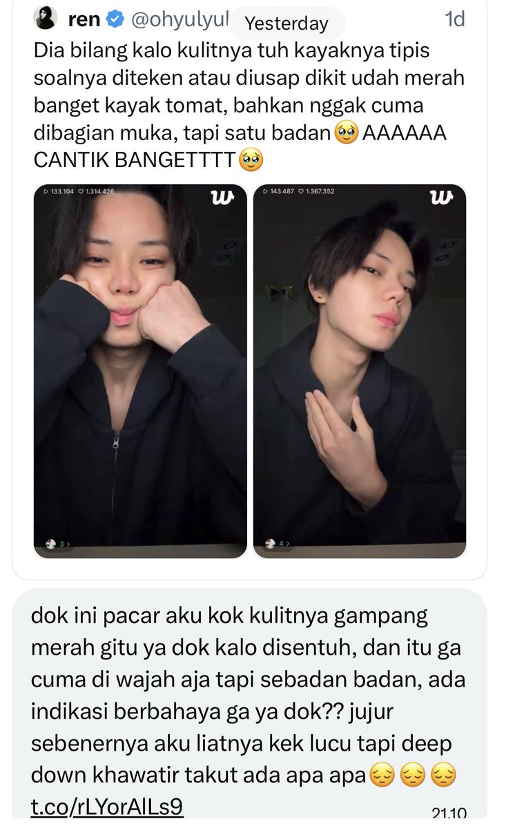 AymanAlatas's tweet photo. Kalo indikasi berbahaya ini harus cek ke dokter kulitnya tapi bisa jadi dasarnya kulitnya sensitif atau mungkin ditambah faktor pemberat lain.
Kepikiran Dermatografisme juga tapi ya harus diperiksa langsung. https://t.co/KJWAgAFC4q