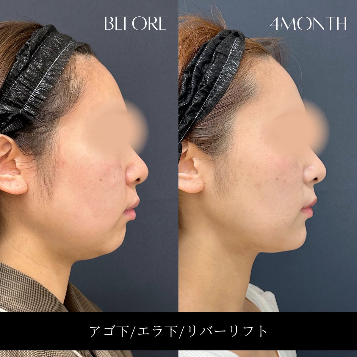 _RIVERCLINIC's tweet photo. 下顎骨のライン（ジョーライン）が見えるだけで、横顔の印象はかなり変わります。

顔の脂肪吸引で除去できるのは皮下脂肪まで。
そのため、広頚筋の厚みや深い脂肪層、骨格そのものにはアプローチできません。

つまり、最終的な仕上がりには元々の骨格のポテンシャルも関係します。

ただ顎下腺が発達している方は、術後に顎下腺ボトックスを併用することで、さらにフェイスラインがスッキリ見えることもあります。

「脂肪だけが原因」とは限らないので、一人ひとりに合わせた治療提案が大切です。

#脂肪吸引 #顔の脂肪吸引  #リバークリニック #戸田貴之