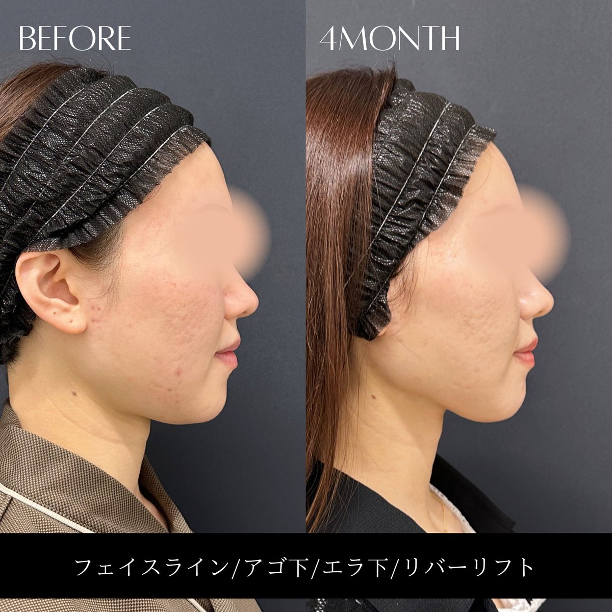 _RIVERCLINIC's tweet photo. 下顎骨のライン（ジョーライン）が見えるだけで、横顔の印象はかなり変わります。

顔の脂肪吸引で除去できるのは皮下脂肪まで。
そのため、広頚筋の厚みや深い脂肪層、骨格そのものにはアプローチできません。

つまり、最終的な仕上がりには元々の骨格のポテンシャルも関係します。

ただ顎下腺が発達している方は、術後に顎下腺ボトックスを併用することで、さらにフェイスラインがスッキリ見えることもあります。

「脂肪だけが原因」とは限らないので、一人ひとりに合わせた治療提案が大切です。

#脂肪吸引 #顔の脂肪吸引  #リバークリニック #戸田貴之