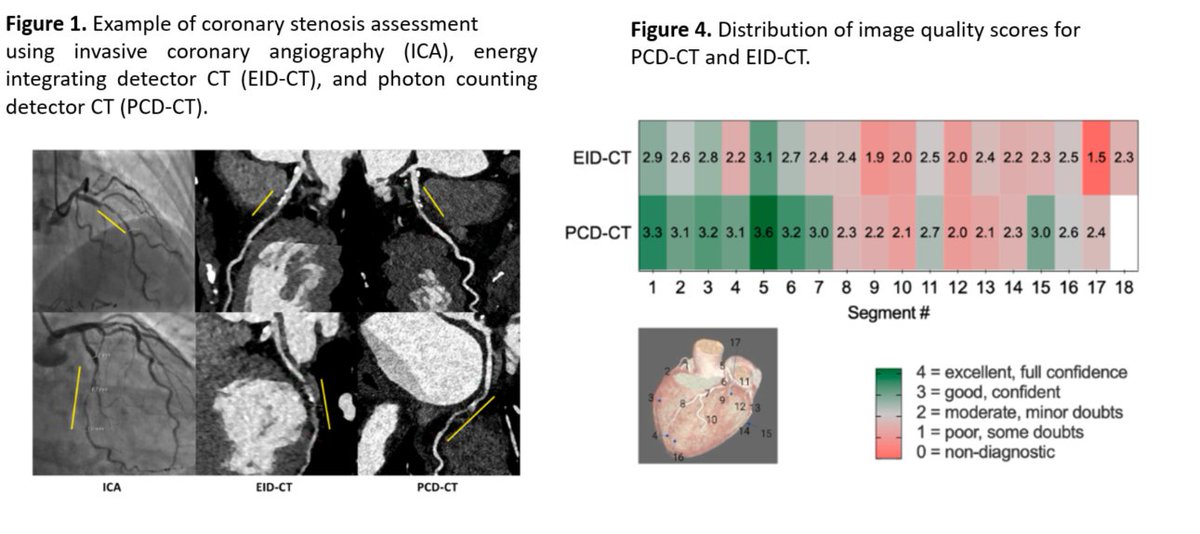 journalCCT's tweet photo. Sharper images with lower dose: Skoog et al. found that standard-resolution PCD-CT matched conventional CCTA for stenosis grading while improving image quality and reducing radiation and contrast exposure. A promising step for routine coronary imaging.  

https://t.co/Q2V9SW8qKj https://t.co/4hqFGC7SgW