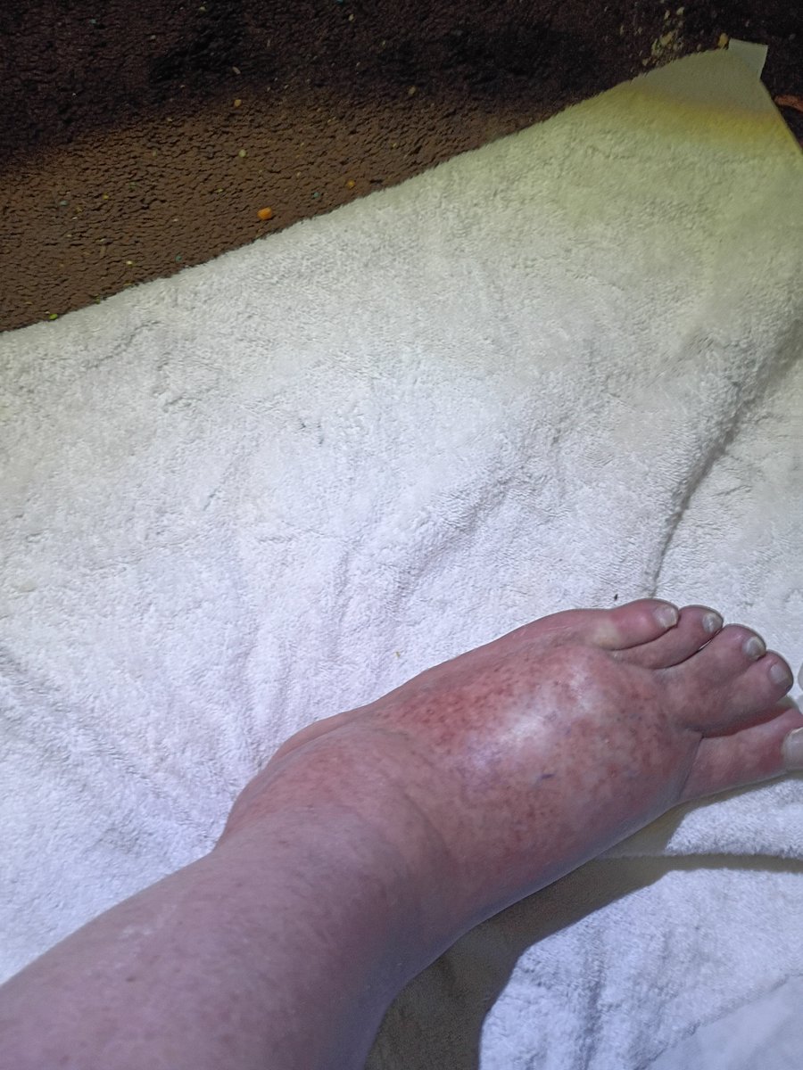 ScottBrown4fun's tweet photo. If I don't respond don't worry I am having major pain issues from diabetic neuropathy.  I'll be back https://t.co/06jXBLXibF