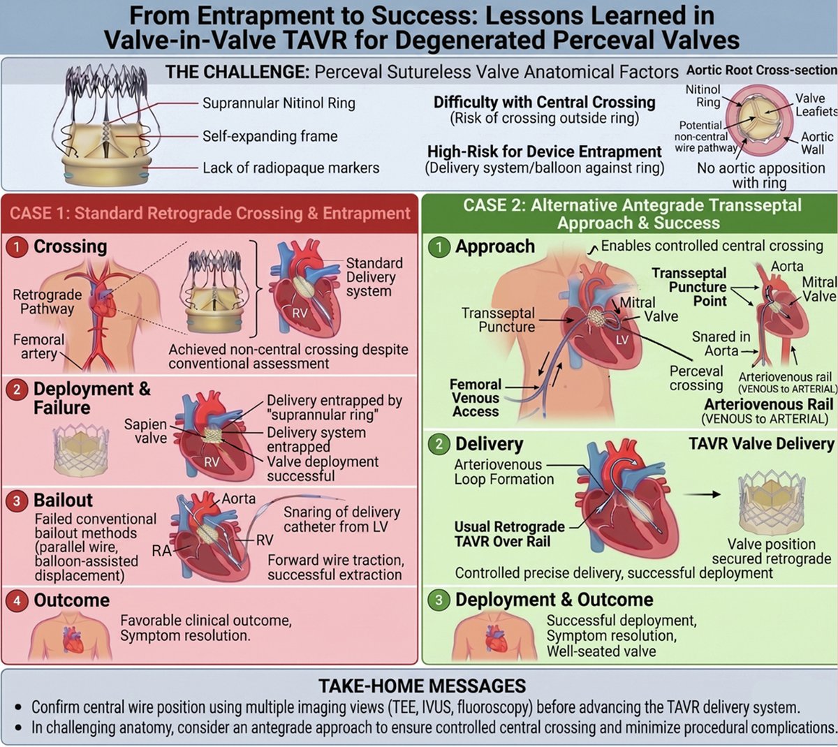 JACCJournals's tweet photo. Here are 2 cases highlighting the importance of preprocedural planning, advanced imaging guidance, &amp; alternative access &amp; crossing strategies when performing ViV-TAVR in Perceval valves: https://t.co/G27qMOonTt #JACCCaseReports #TAVR https://t.co/Smn9pwm93N