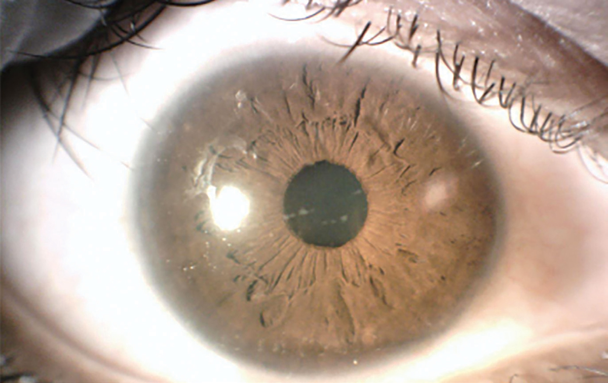 revoptom's tweet photo. "My Patient Has a Corneal Dystrophy… Now What?" — With a little guidance, the everyday practitioner can conquer detection and treatment.
📖: https://t.co/jz0ZPFeNSt

Browse the full "Now What?" series at https://t.co/DbGv0z7XPk🔗
#optometry #eyecare #eyedoctor #cornea https://t.co/FxohIUkPKb