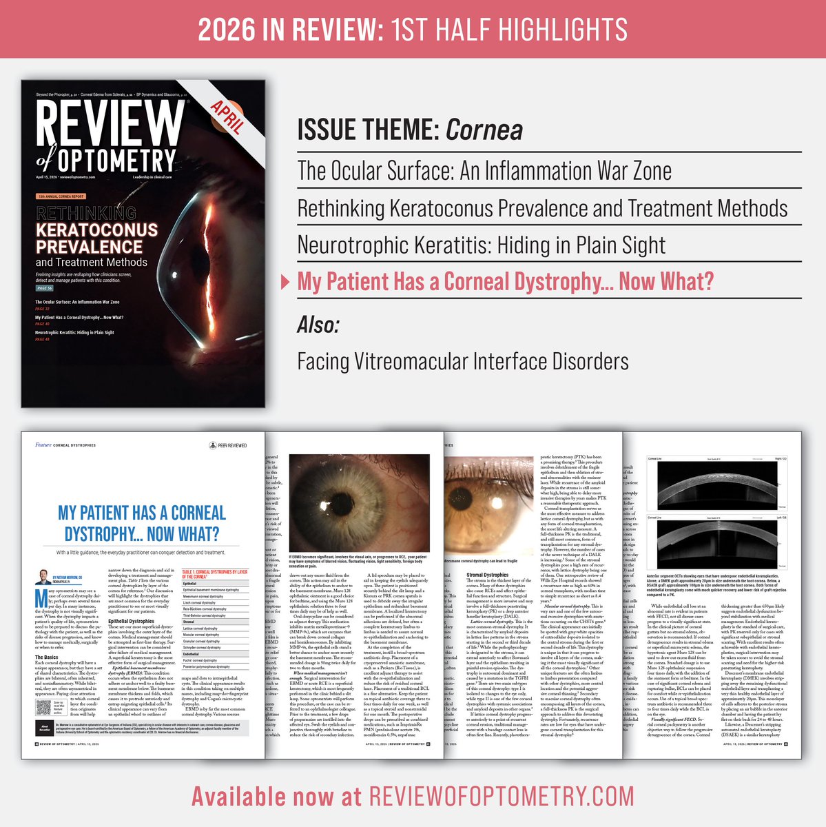 revoptom's tweet photo. "My Patient Has a Corneal Dystrophy… Now What?" — With a little guidance, the everyday practitioner can conquer detection and treatment.
📖: https://t.co/jz0ZPFeNSt

Browse the full "Now What?" series at https://t.co/DbGv0z7XPk🔗
#optometry #eyecare #eyedoctor #cornea https://t.co/FxohIUkPKb