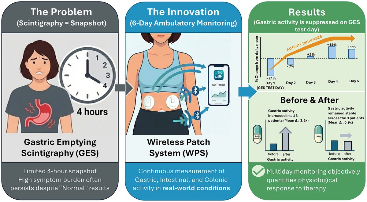NGMJournal's tweet photo. 🆕🔥Beyond #Snapshot: Overcoming #GES limitations to characterize gastric phenotypes &amp; therapeutic responses using a 6Day #AmbulatoryWearableMonitor‼️
🎯Continuous monitoring may better reflect real-world GI function #Gastroparesis💡
👉https://t.co/6b9684585X
@ANMSociety @esnm_eu https://t.co/u4Coz5DynI
