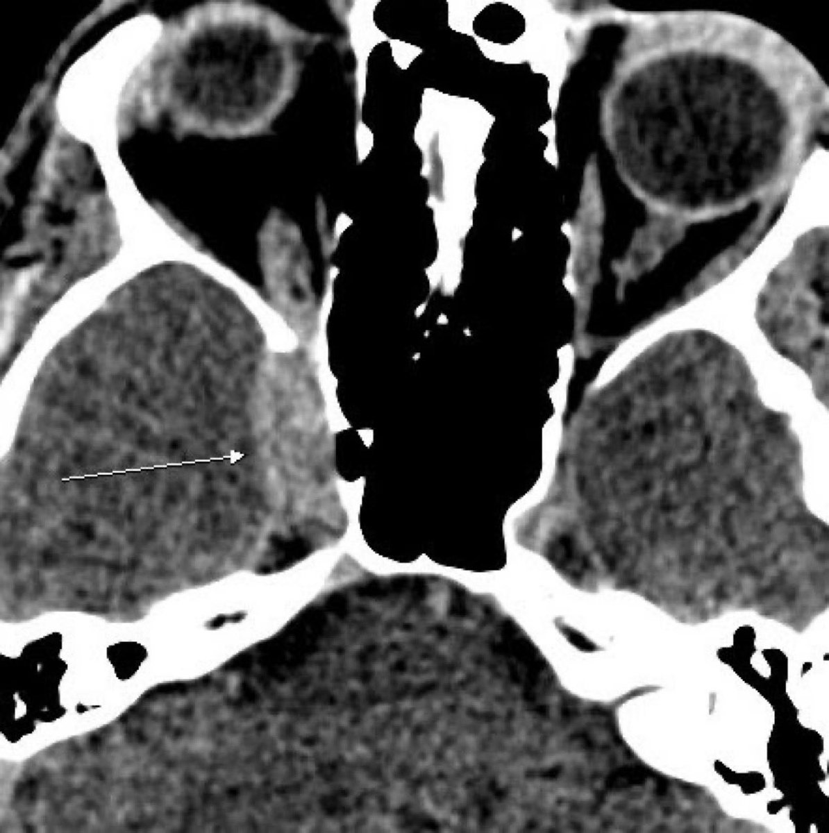 DrAyubaD's tweet photo. Young adult with severe headache, fever, periorbital swelling, proptosis and cranial nerve palsies (III, IV, VI).

What is the diagnosis? https://t.co/lgEFItifX0