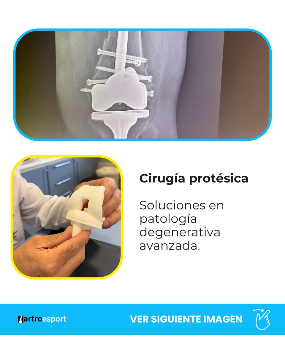 DoctorFraguas's tweet photo. La cirugía ortopédica requiere experiencia, especialización y una toma de decisiones precisa en cada caso.
centrados traumatología y cirugía ortopédica avanzada, con especial dedicación al tratamiento de patologías complejas de rodilla, hombro y otras articulaciones. https://t.co/peSfCj8OpO