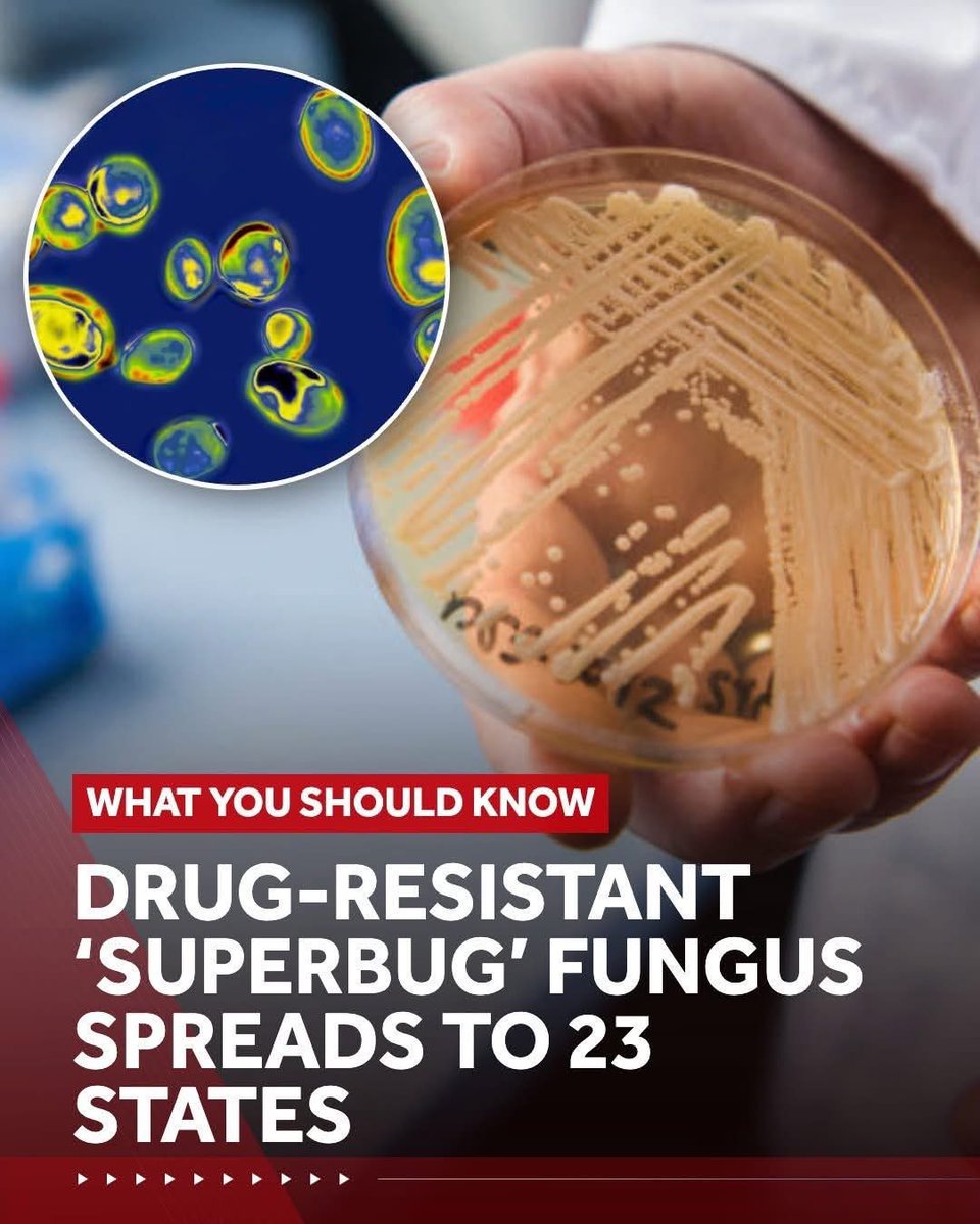 AveMariaBiotech's tweet photo. Drug-resistant Candida auris has now been reported in 23 U.S. states.

This emerging fungal threat highlights the need for early detection and continuous surveillance.

#CandidaAuris #Biosecurity #PublicHealth #BioDetector https://t.co/kngWoTImML