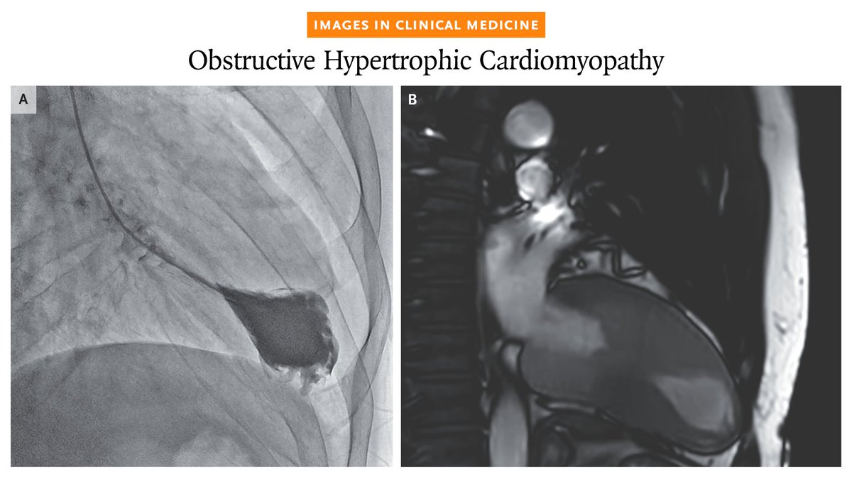 NEJM's tweet photo. A 31-year-old man was evaluated for an abnormal ECG. Echocardiography revealed marked ventricular hypertrophy. Subsequent imaging (shown in a video) showed near-complete apposition of the ventricular walls during systole. 

Read the full case details in the Images in Clinical Medicine article “Obstructive Hypertrophic Cardiomyopathy”: https://t.co/CZHl4Q5hHy