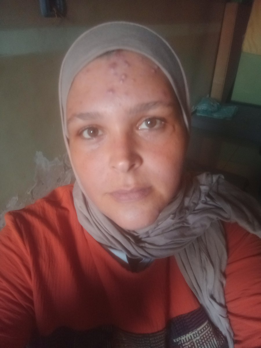 NonoKhaled81156's tweet photo. 💔 بعد الولادة أصبح التعب يرافقني كل يوم، وجسدي لم يعد يحتمل. ظهرت لي حبوب مؤلمة وأحتاج إلى العلاج بأسرع وقت ممكن، لكن ظروفي صعبة جدًا. أرجوكم لا تنسوني من دعائكم ودعمكم، فأنا أحاول أن أتعافى لأبقى قوية من أجل أطفالي. 🤍🙏
https://t.co/PFhoMMDsXg https://t.co/jiz128t35M