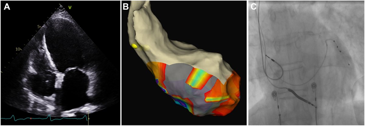 HRS_CaseReports's tweet photo. Mechanical septal debulking to enable left bundle branch pacing through dense septal scar: A bailout technique 
@NegreiraMartin @cardiologia_HUG 
https://t.co/GScnJOteIk https://t.co/C1PkeHJp39